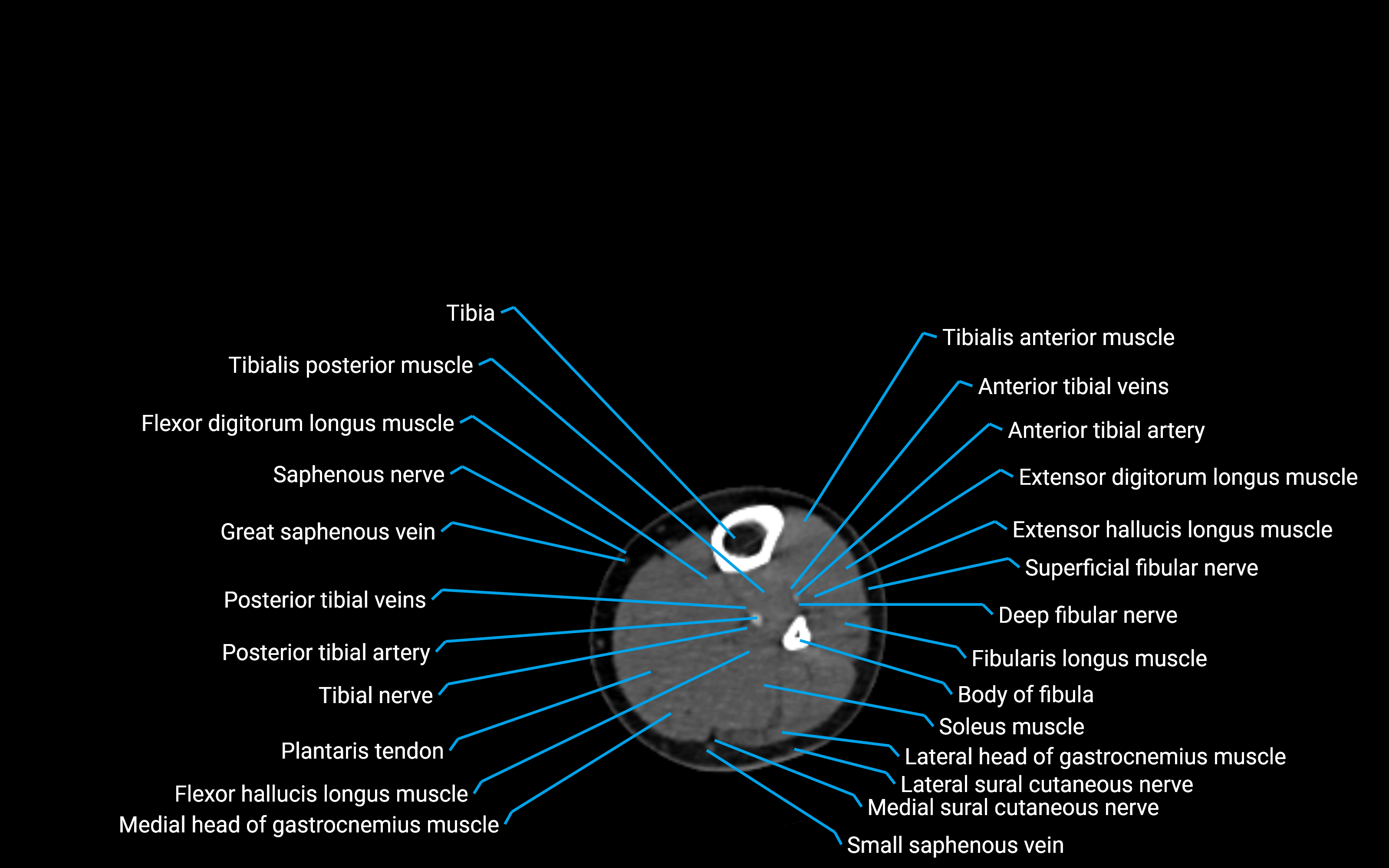CT Lower leg axial cross sectional anatomy labelled image 114 (2).png